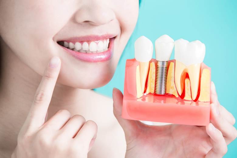 a closeup of dental implants in Edmonton, AB