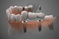 a patient with dental implants in Edmonton, AB