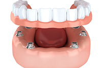 a patient with dental implants in Edmonton, AB